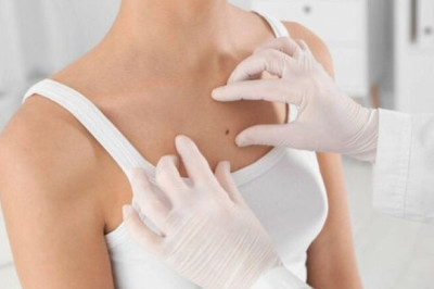 علاج إزالة علامات الجلد